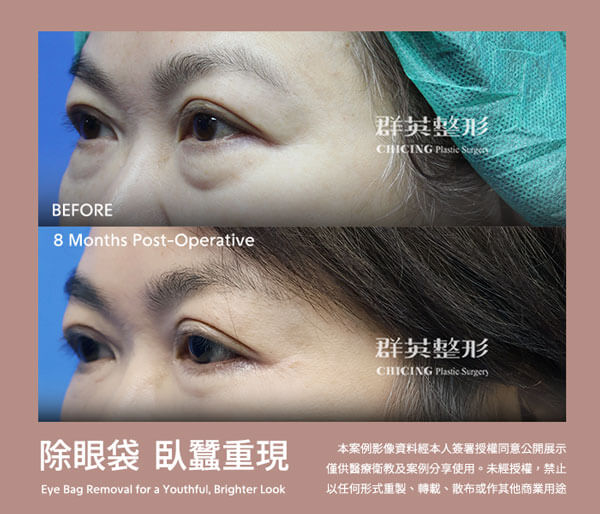 台中群英 老化型眼袋 眼袋外開 填補淚溝 最新案例