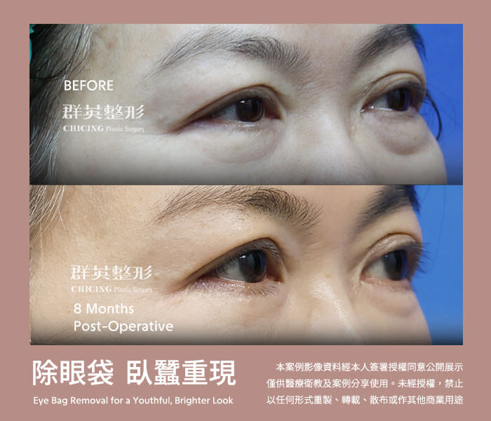 台中群英 老化型眼袋 眼袋外開 填補淚溝 最新案例